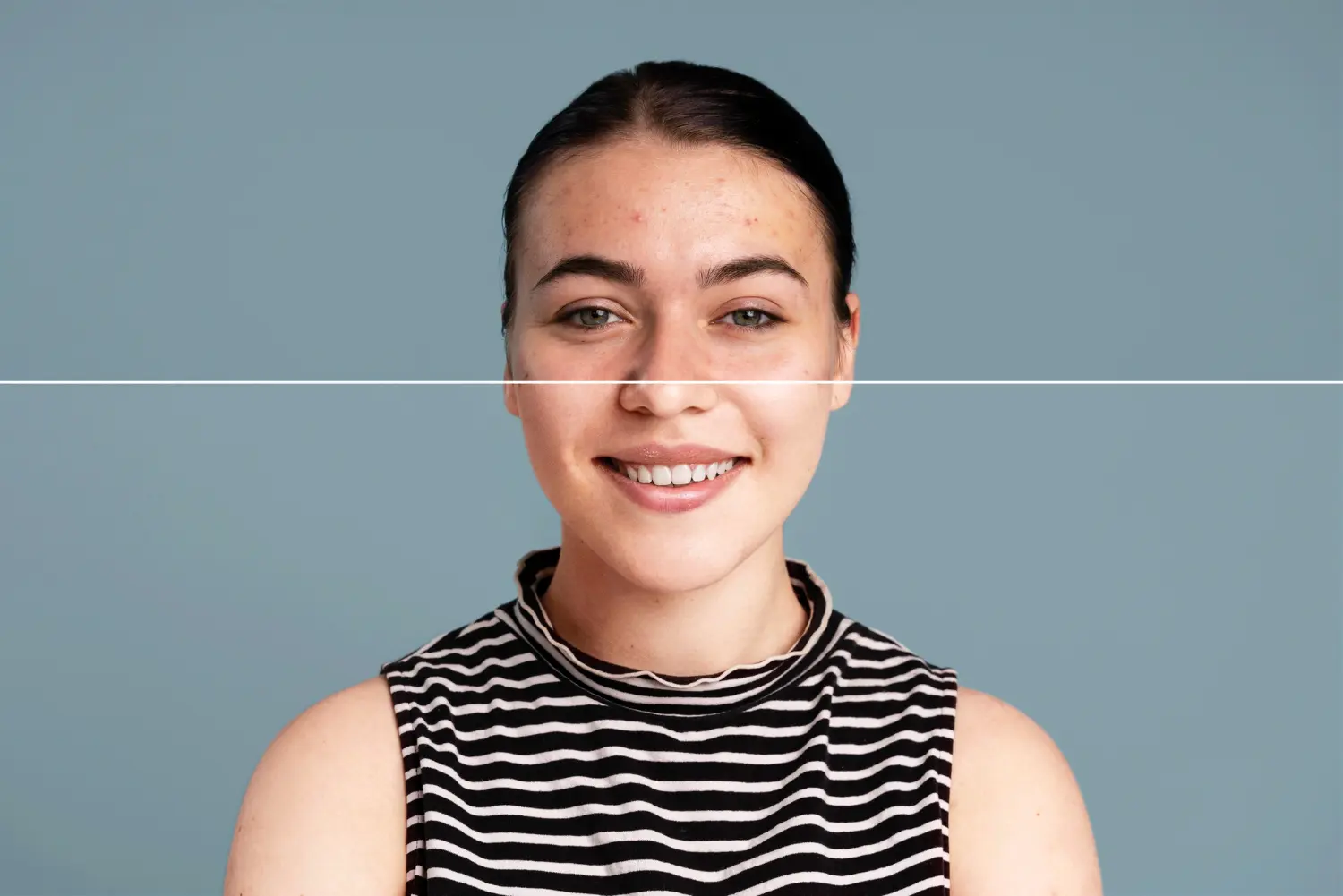 What Is the Most Effective Way to Treat Acne?