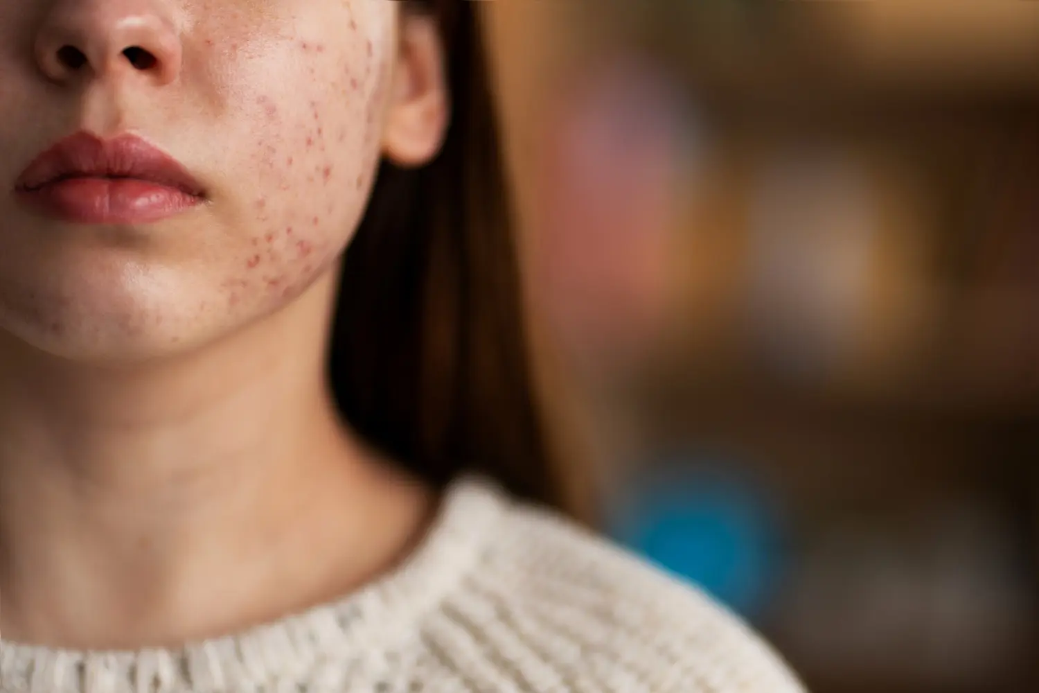 Best Treatments for Acne Scars That Won’t Break the Bank